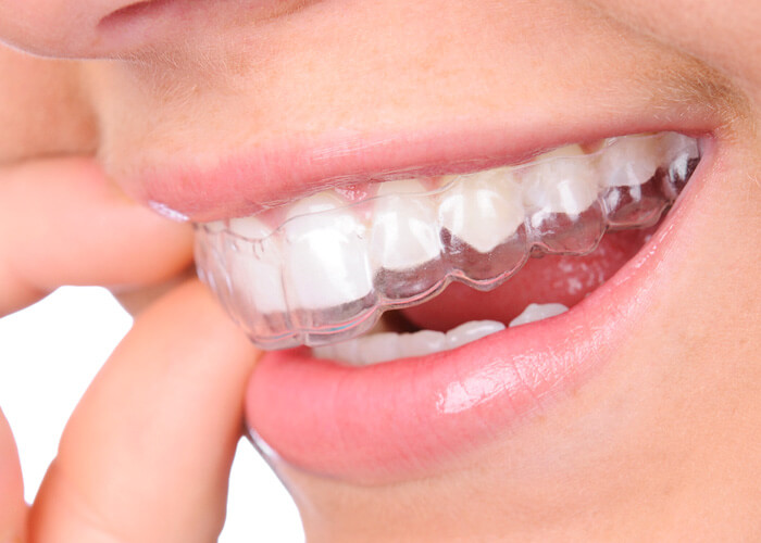 The Economic Advantages of Choosing Invisalign Over Conventional Orthodontic Methods