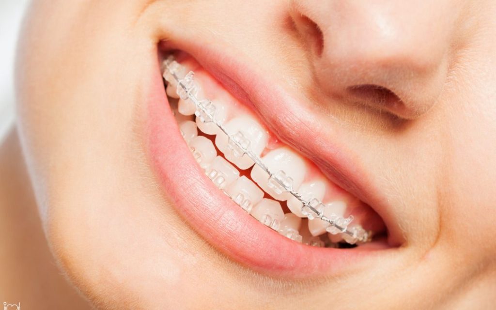 How Braces Address Common Childhood Dental Habits and Their Long-Term Effects